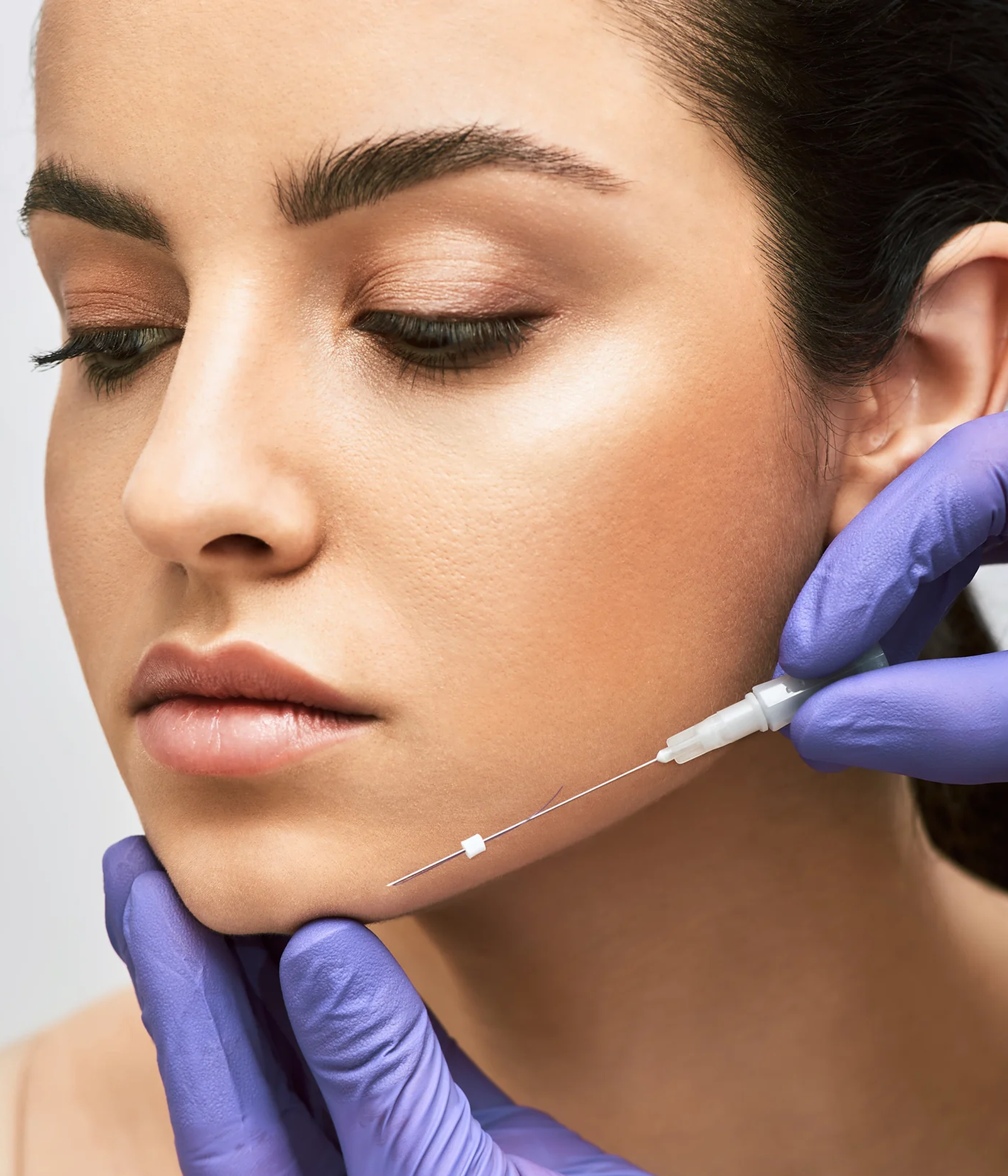 Fios de PDO (bioestímulo)