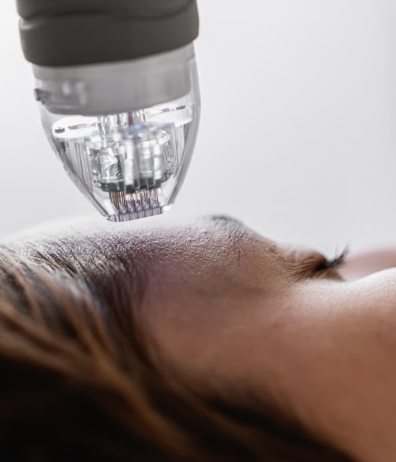 Radiofrequência microagulhada 